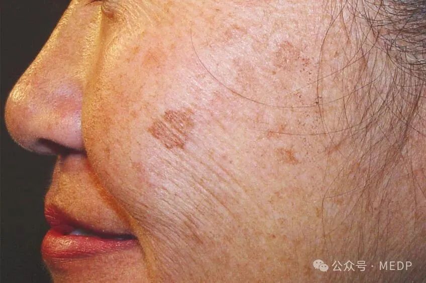 老年斑、晒斑、日光性雀斑是一回事吗？